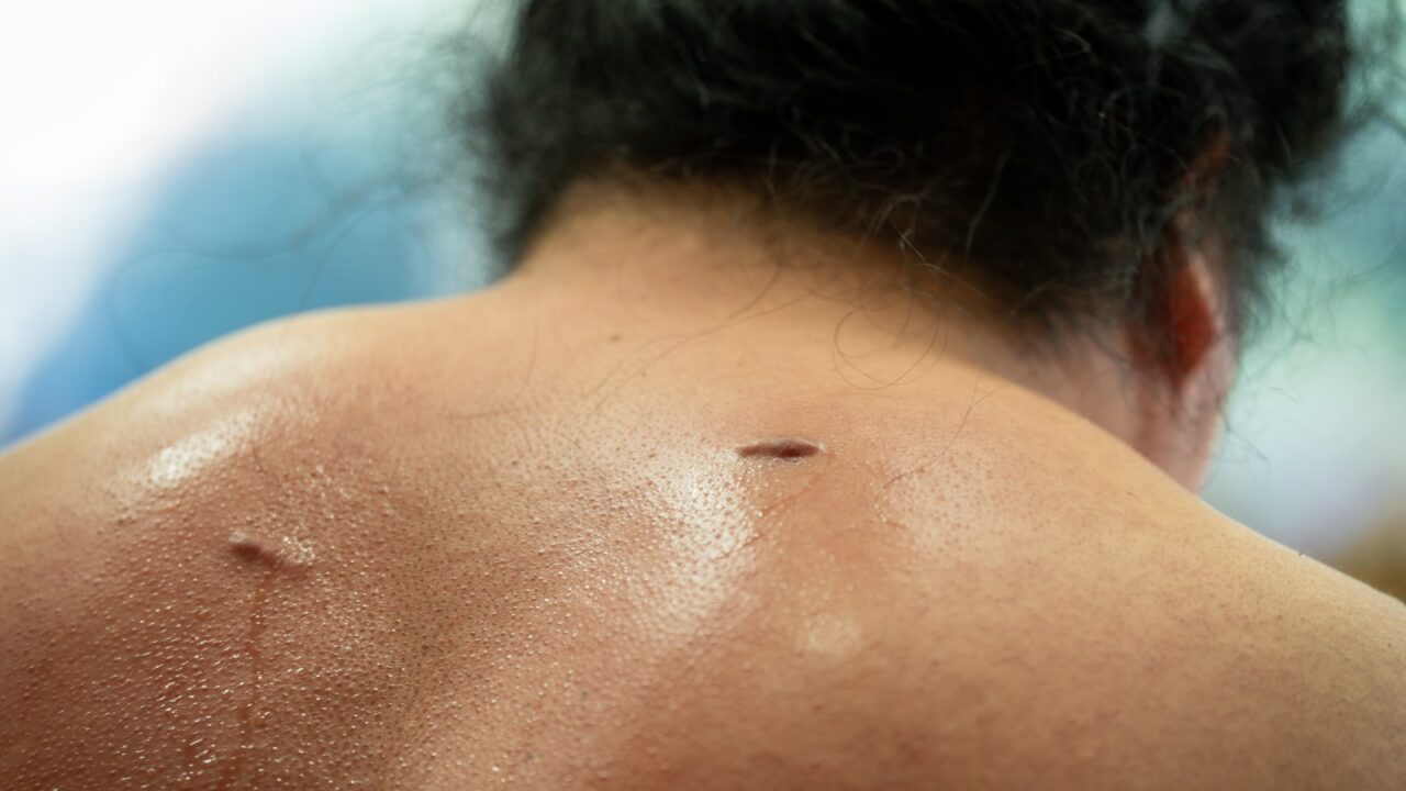 Flea Bites on Humans: Signs, Treatment & Prevention