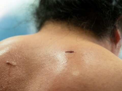 Flea Bites on Humans: Signs, Treatment & Prevention